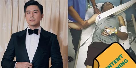 Paulo Avelino Shares Journey Of Recovering From Shoulder .